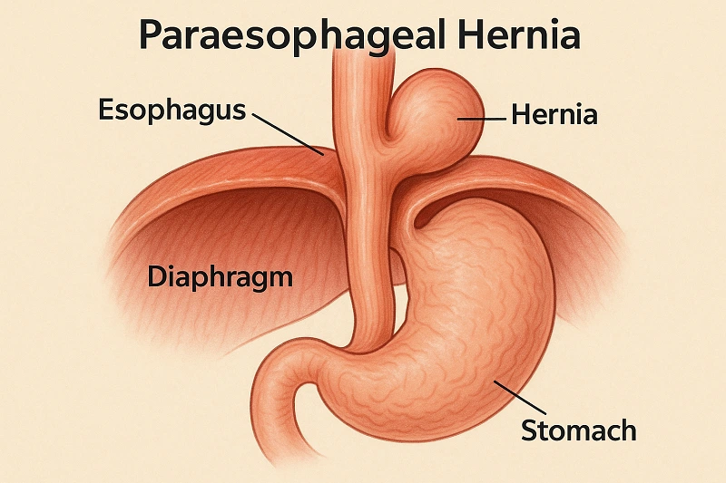Paraesophageal Hernias Surgery in LA