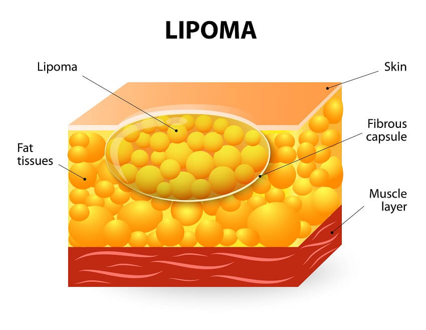 Lipoma Removal