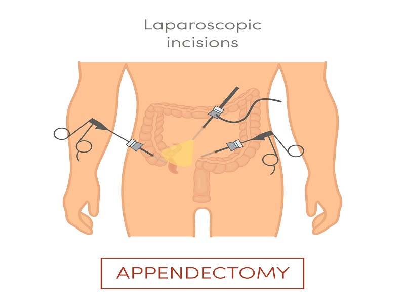 Benefits of Laparoscopic Appendectomy