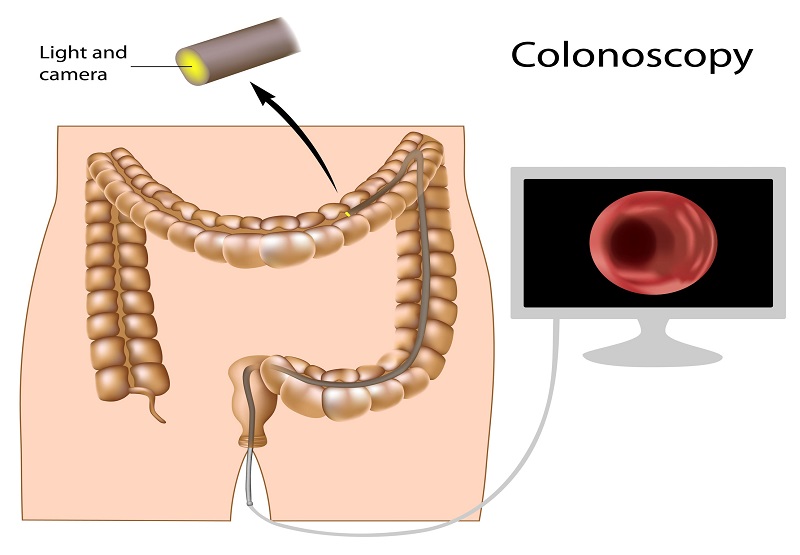 Colonoscopy in Los Angeles