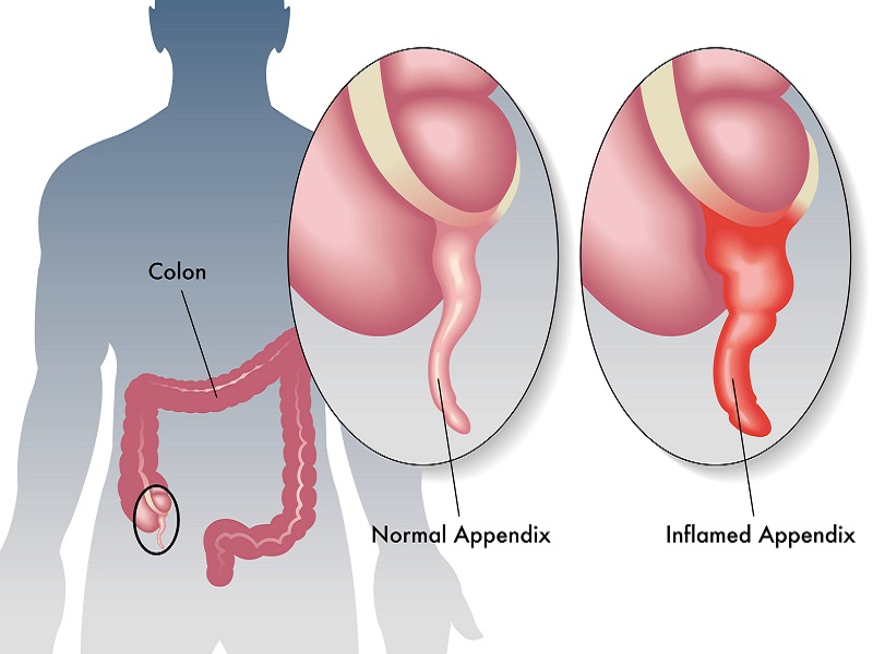 Laparoscopic Appendectomy in Los Angeles . | Tips from Dr. Moein