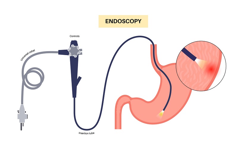 Endoscopy in Los Angeles