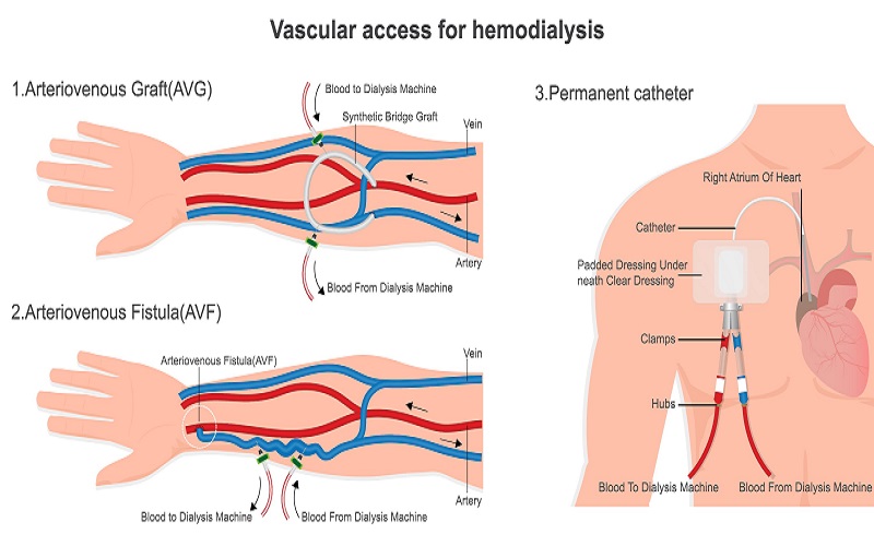 Vascular Access in Los Angeles