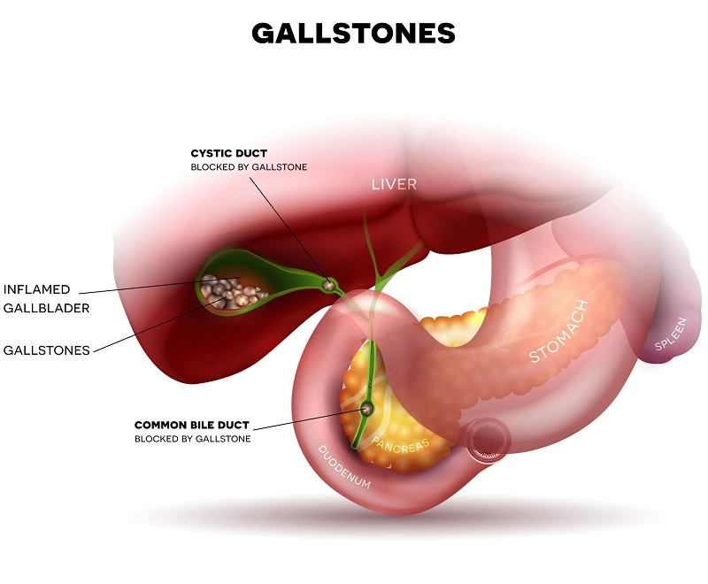 Gallbladder Surgery in Los Angeles
